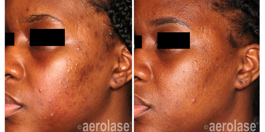 Electrolysis By Linda NeoClear Acne After 4 Treatments Michelle Henry MD