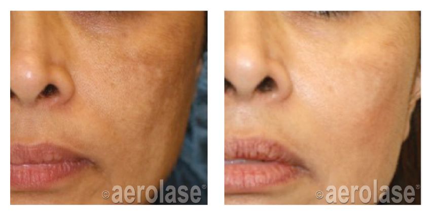 Electrolysis By Linda NeoSkin Melasma After 1 Treatment combined with Hydroquinone Cheryl Burgess MD