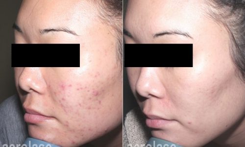Electrolysis By Linda NeoClear Acne After 6 Treatments Spade Skin Care
